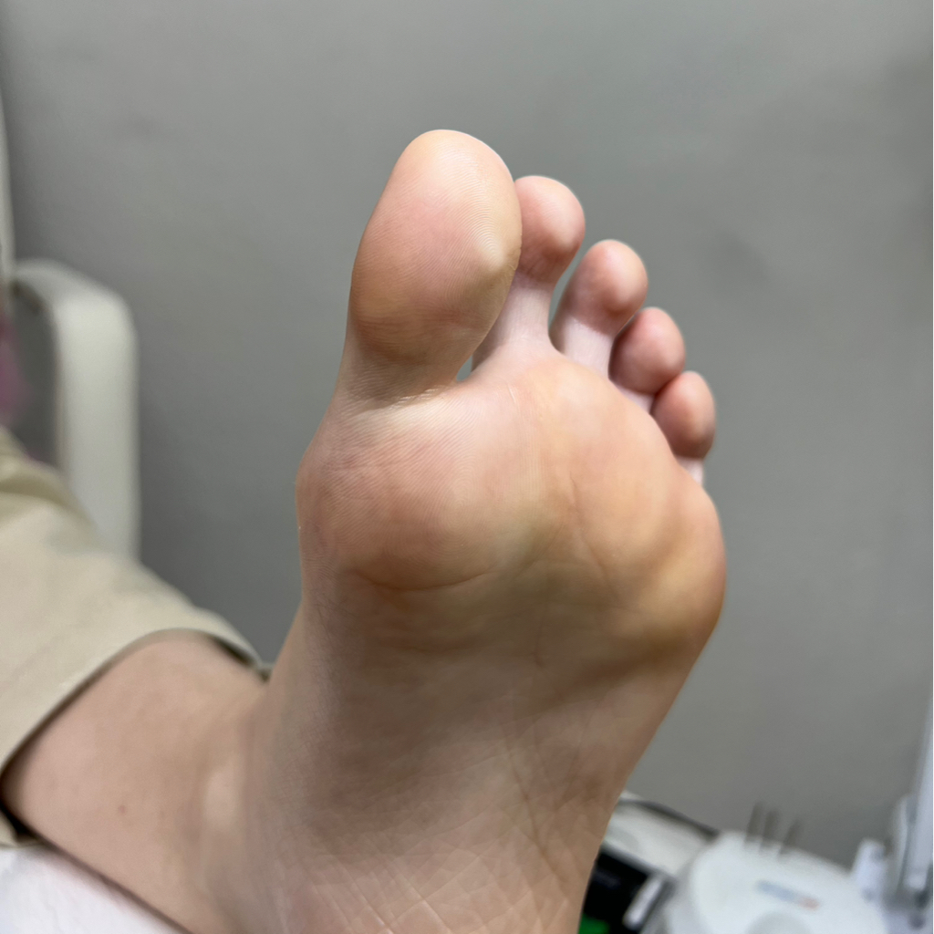 Обработка стопы SMART