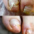 Подологическая зачистка ногтевой пластины (онихогрифоз , онихолизис)