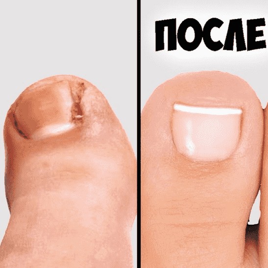 удаление вросшего ногтя ( 1 одна сторона)