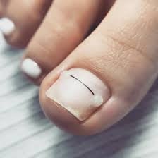 установка титановой нити на ноготь