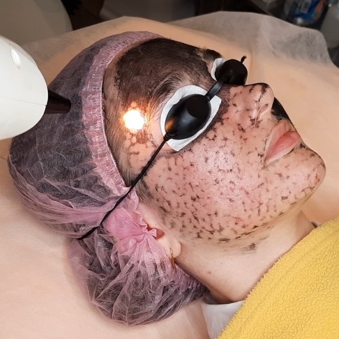 Карбоновый пилинг