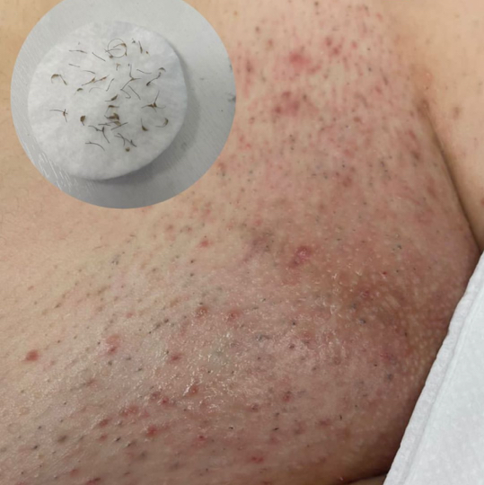 Чистка и лечение вросших зона бикини