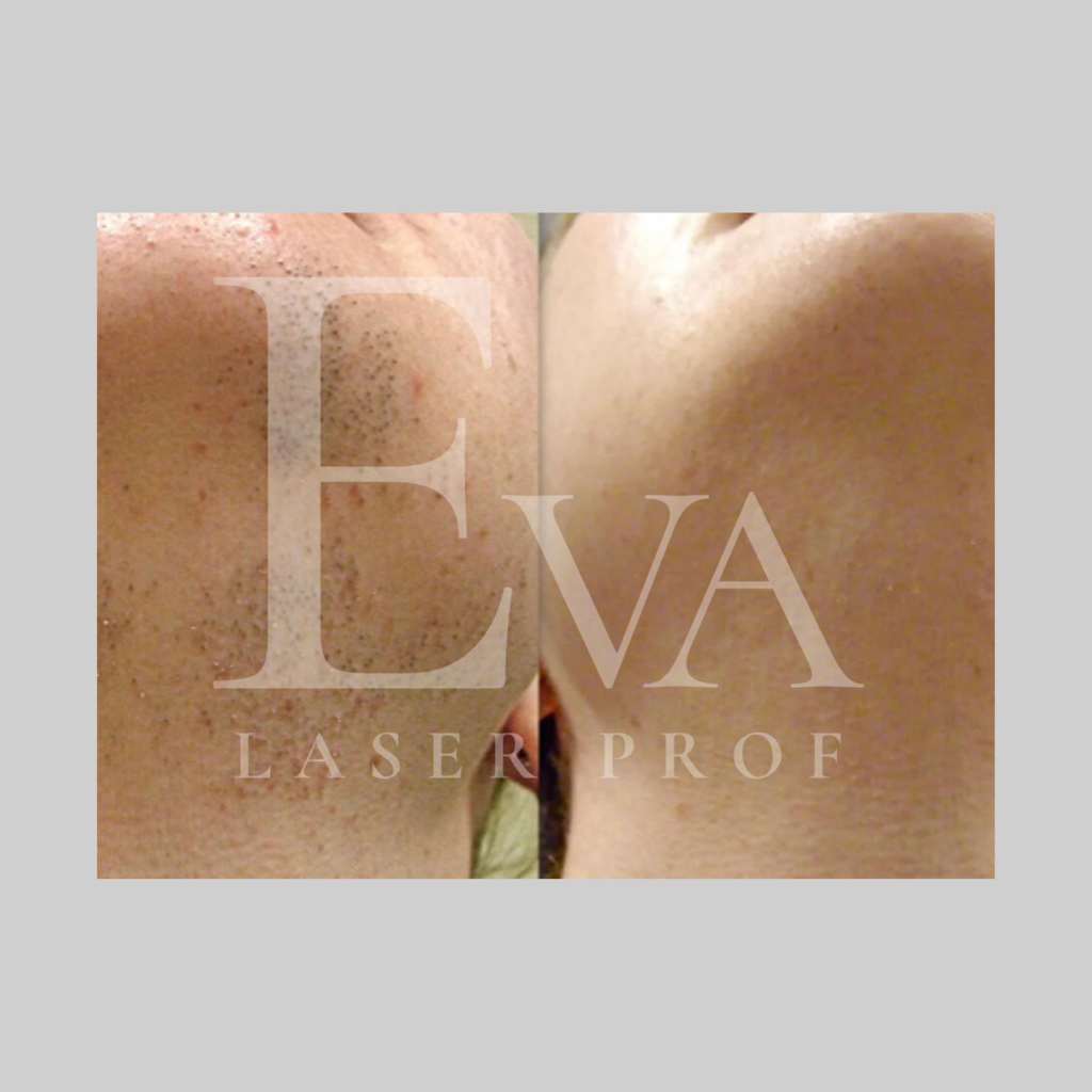 Лазерная эпиляция лица