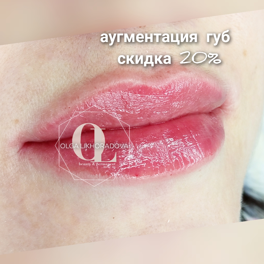 Аугментация губ (контурная пластика)
