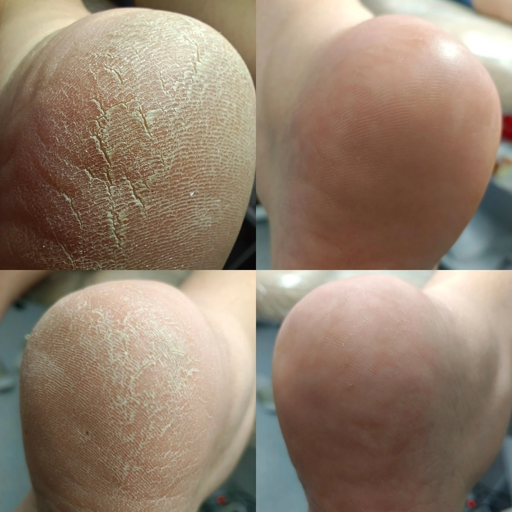 Обработка стопы SMART-дисками