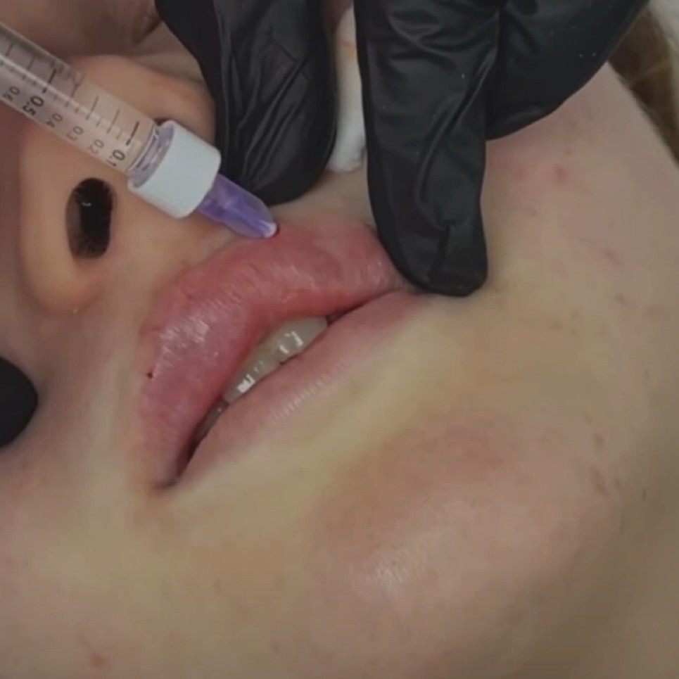 Контурная пластика губ 1 мл Акция