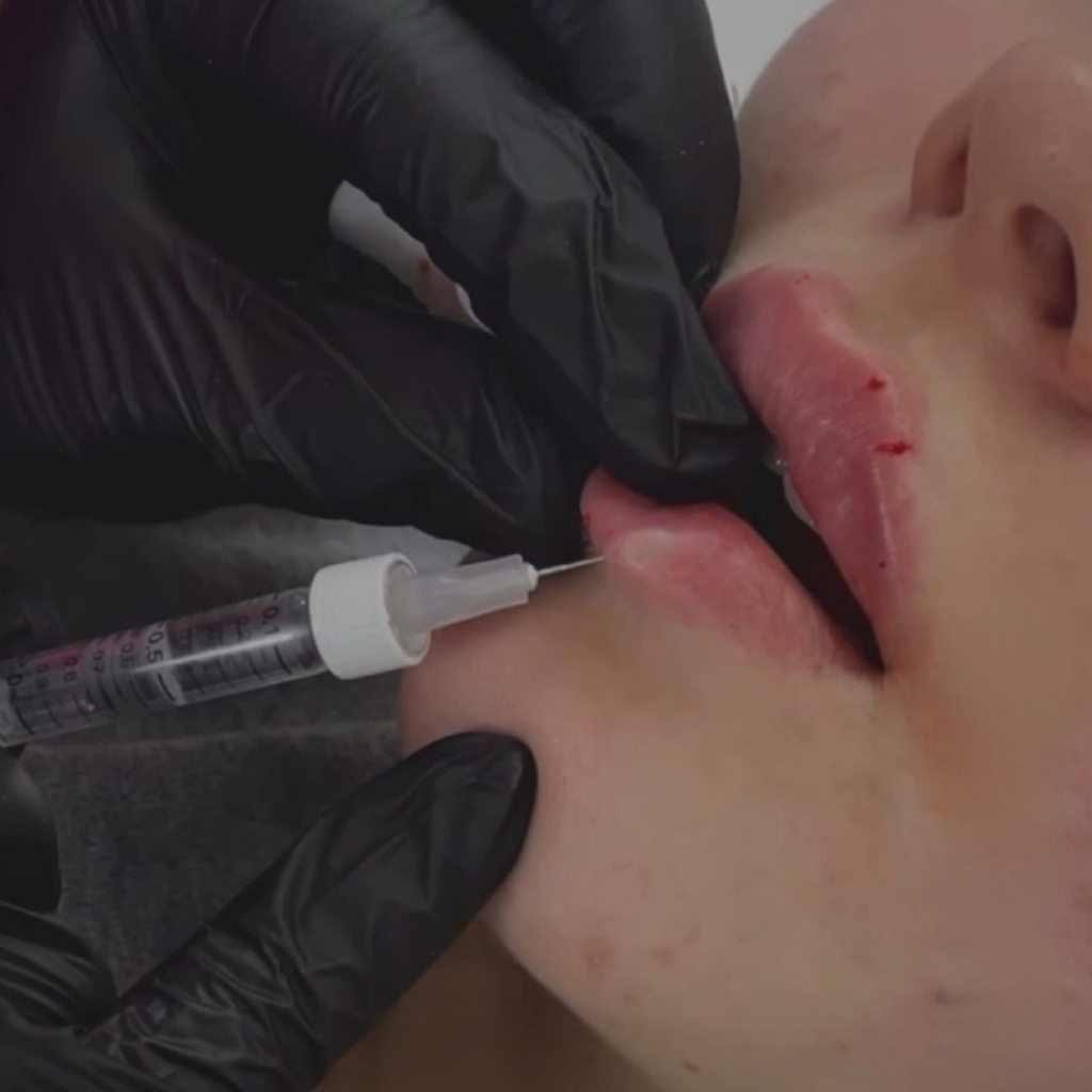 Контурная пластика губ 0.5 мл