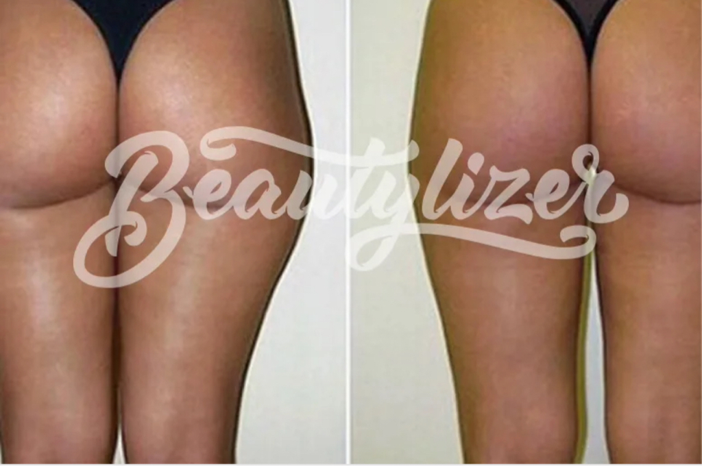 Rsl скульптурирование  Способствует безоперационному уменьшению жировых отложений по всему телу, активизации лимфатической системы и метаболических пр