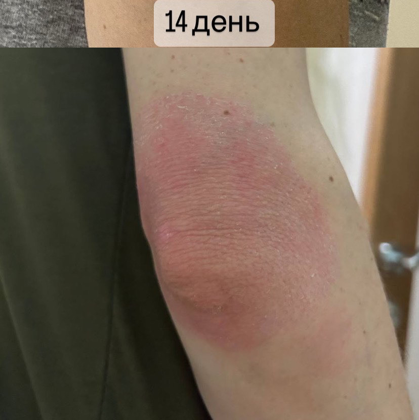 Плазмаліфтинг лікті