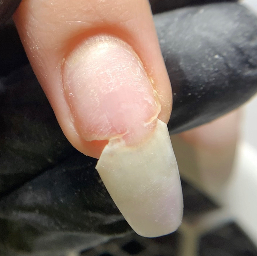 Ремонт 1 ногтя ( клюющие / скрученные / донаращивание )