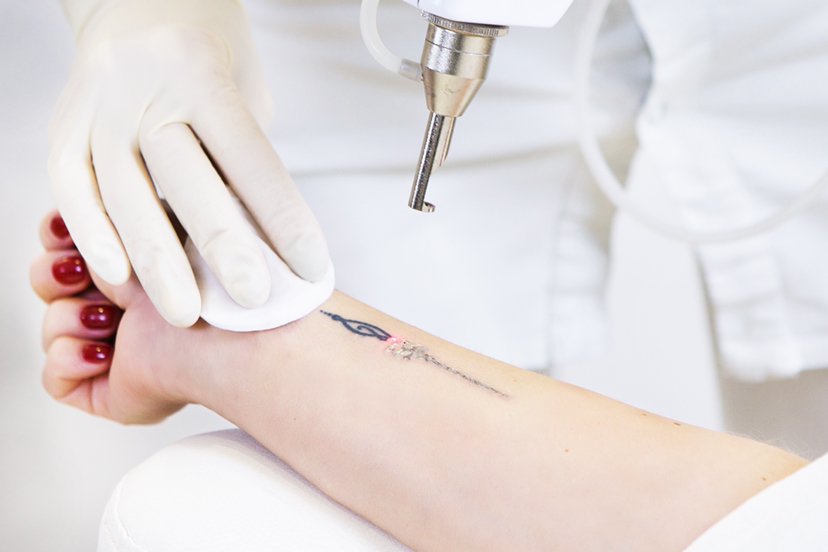 Удаление татуировки до 5*5