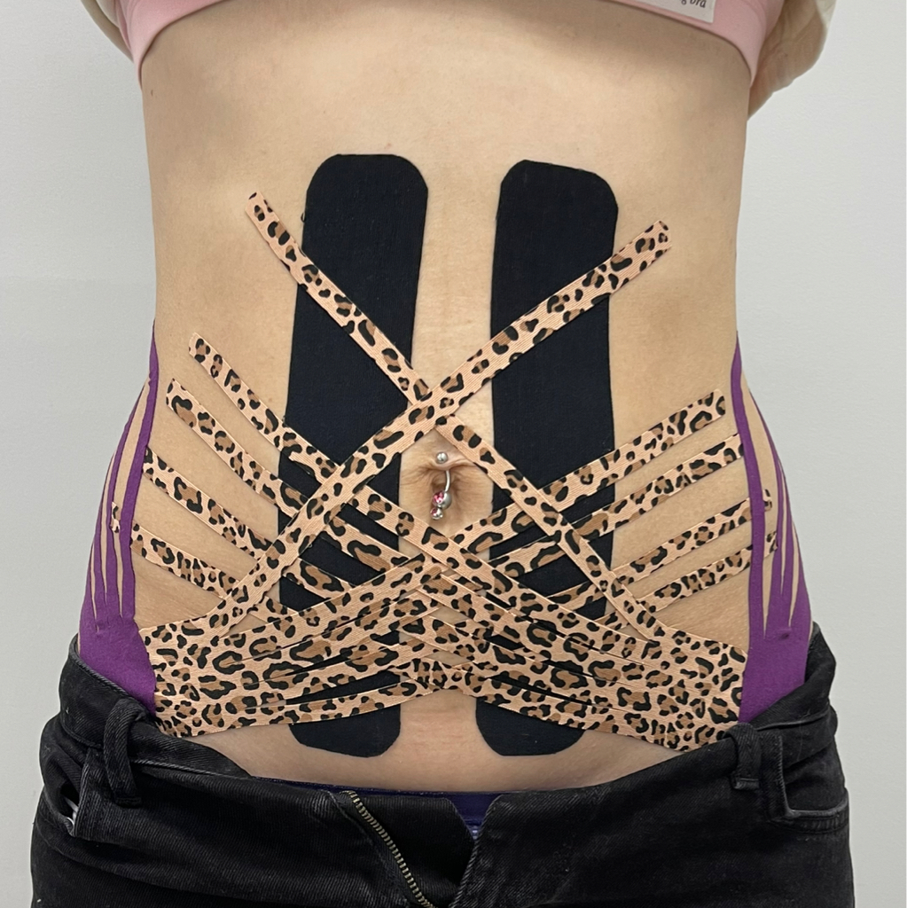 Послеродовое тейпирование