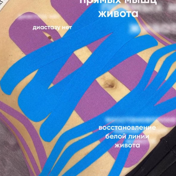 Тейпирование диастаза (взрослый)