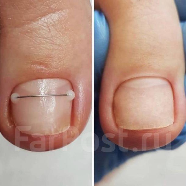 Коррекция титановой нити