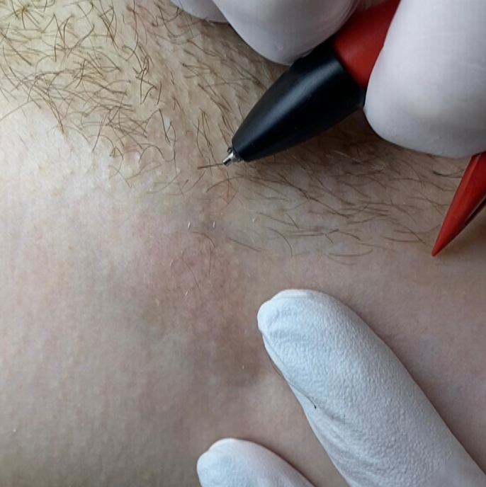 Электроэпиляция 2,5 часа