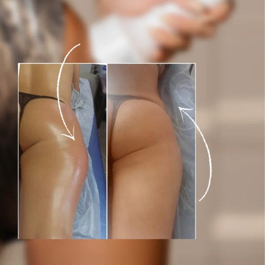 MC (минус 2-5 см с талии за один сеанс)