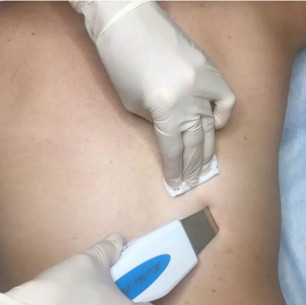 Чистка спины с кислотами