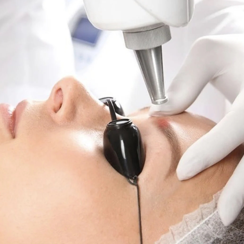 УДАЛЕНИЕ ТАТУАЖА ЛАЗЕРОМ