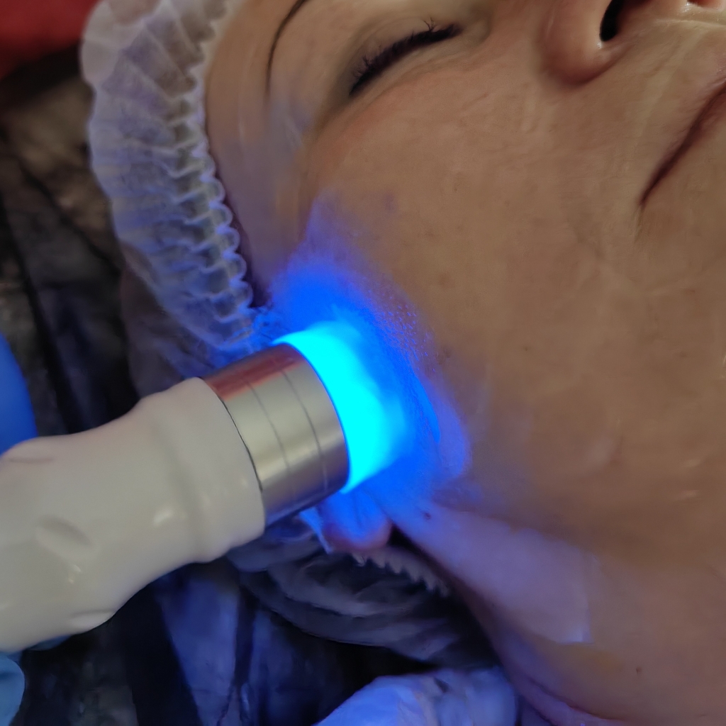 RF лифтинг лицо+шея+декольте