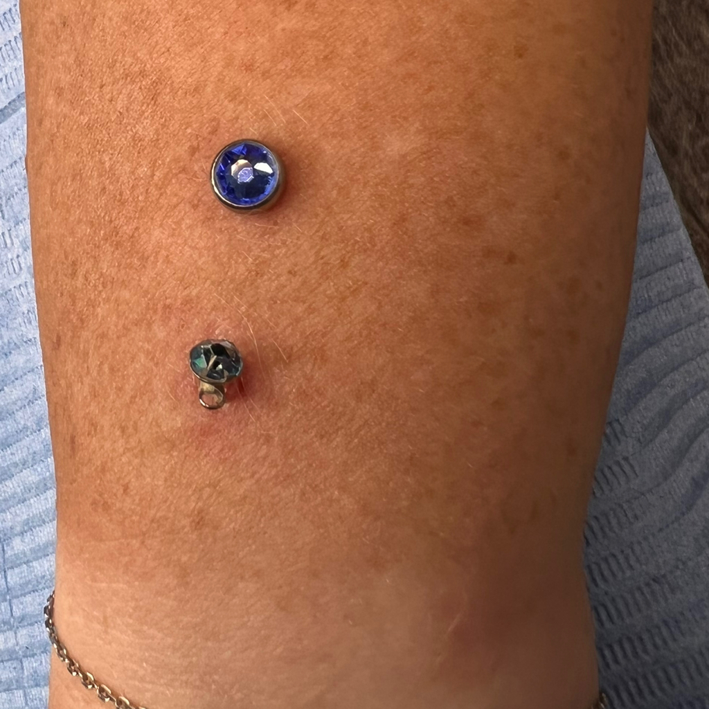 Удаление микродермала