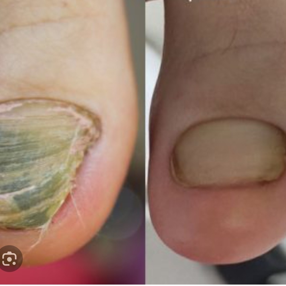 зачистка онихогрифоза ( 2 ногтя)