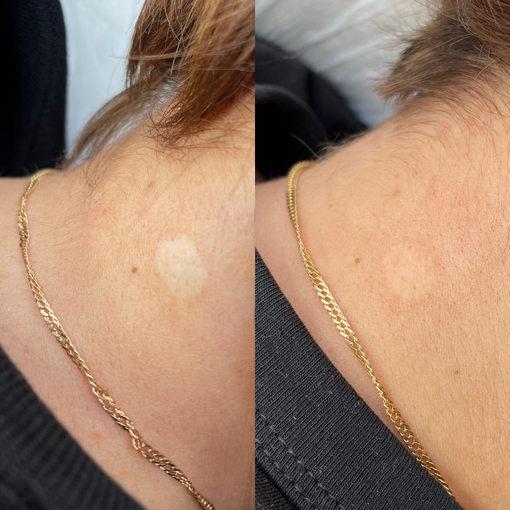 Камуфляж рубцов