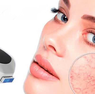 Удаление сосудов/пигментации (всё лицо)