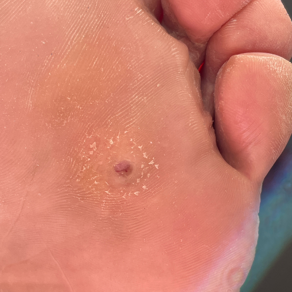 Обработка мозолей/бородавок