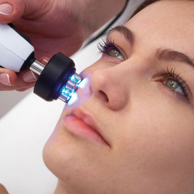 RF-  лифтинг лица