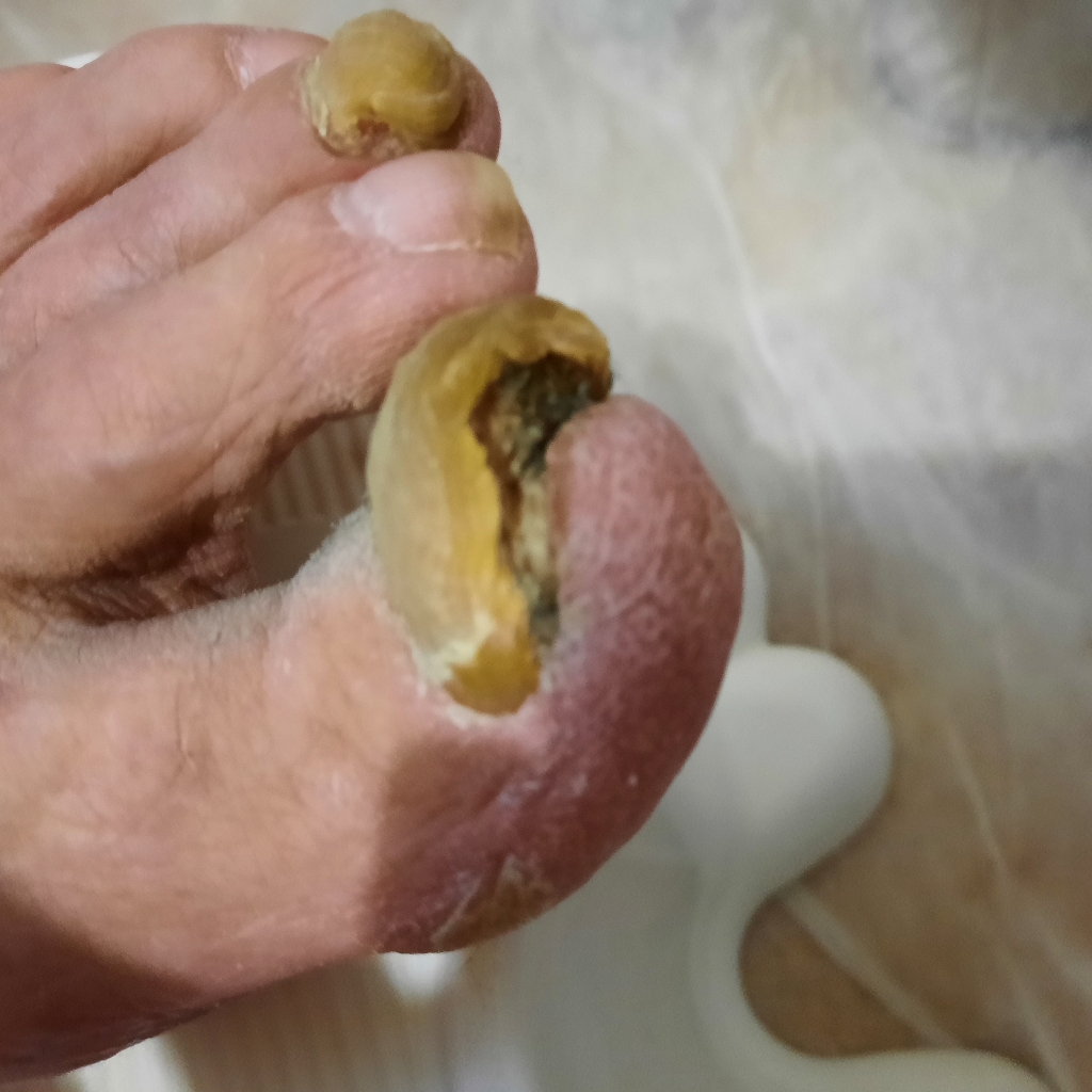 Подологический педикюр