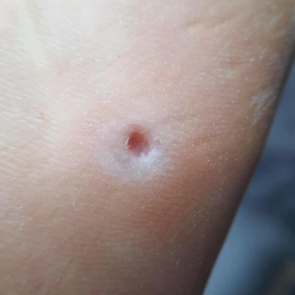 Обработка  мозоли