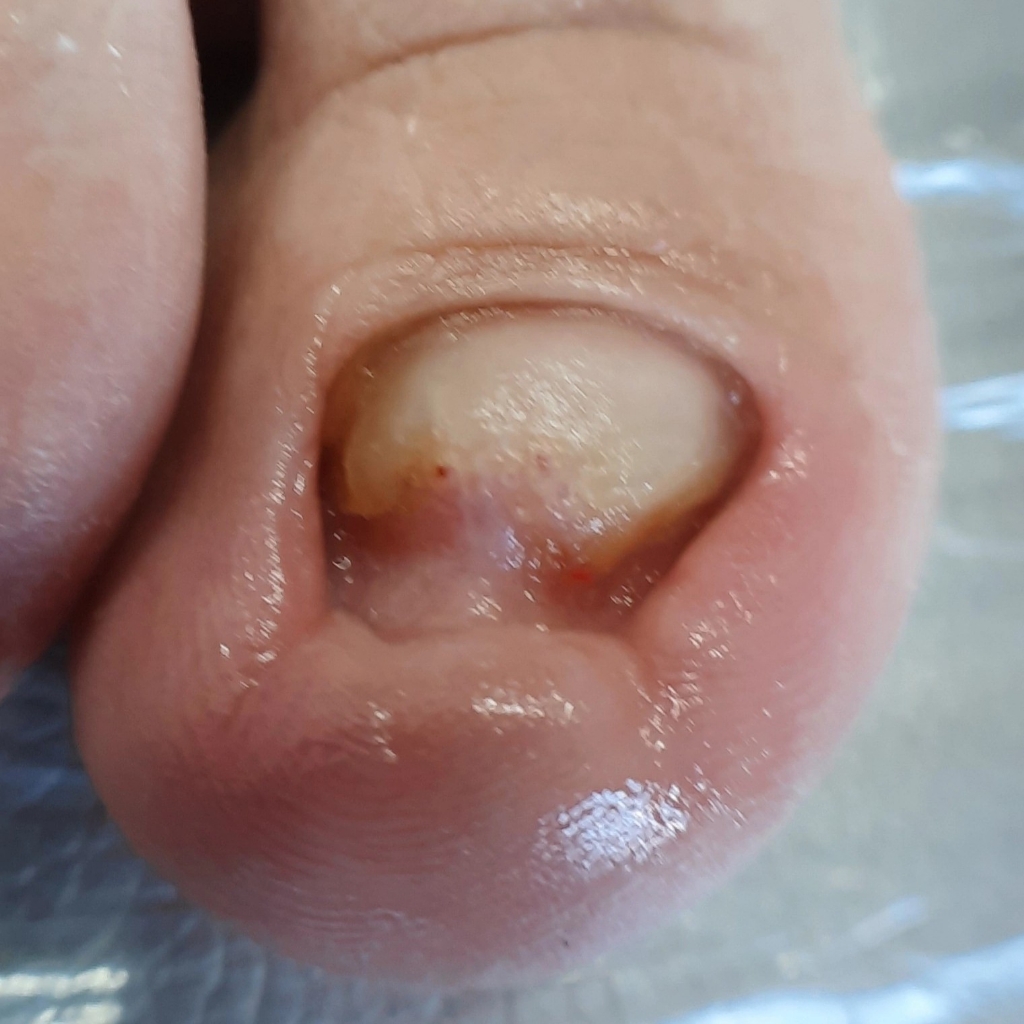 Протезирование ногтей