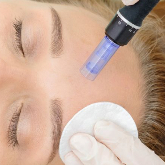 Фракционная мезотерапия