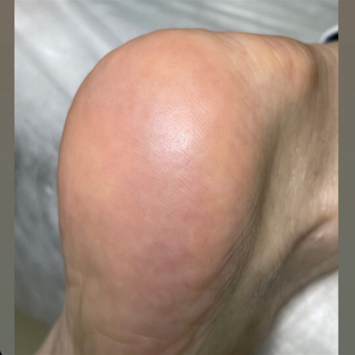 Педикюр «обработка стоп»