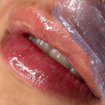 Удаление нежелательных волос на лице (одна зона)