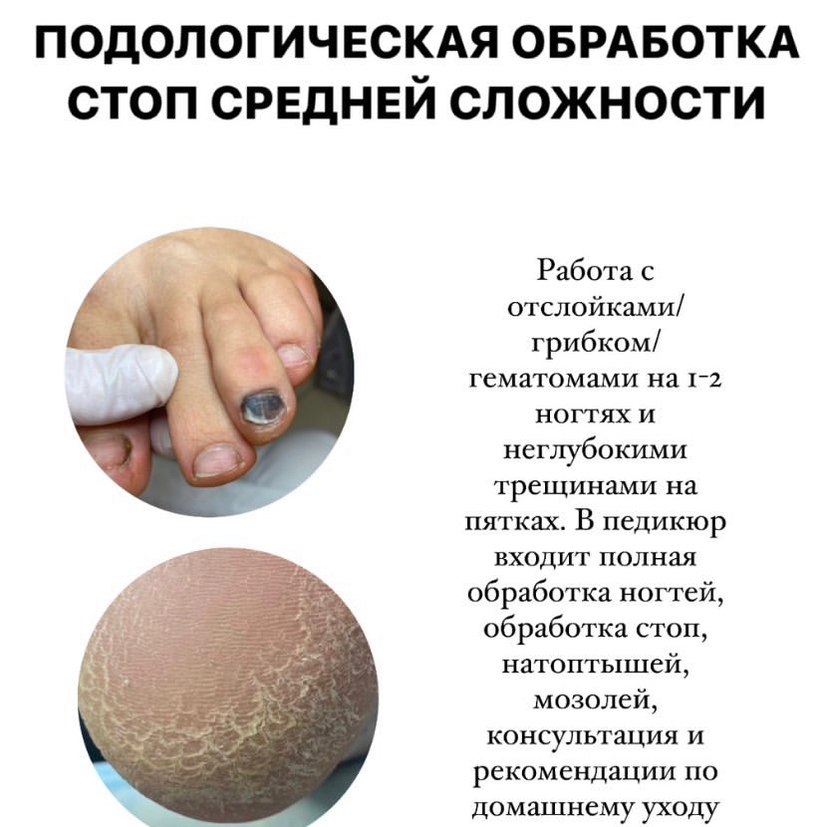 Подологическая обработка стоп средней сложности