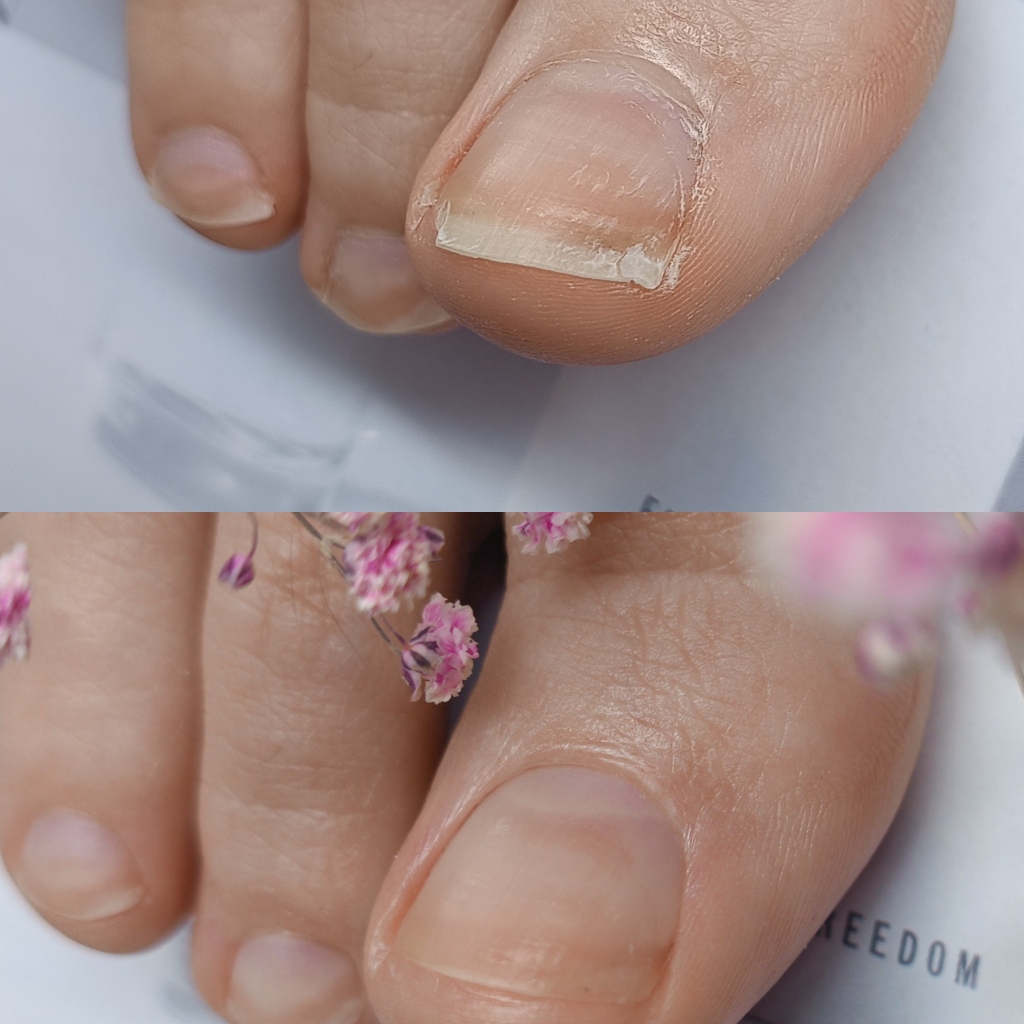 Педикюр пальчиков