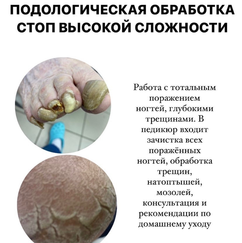 Подологическая обработка стоп высокой сложности