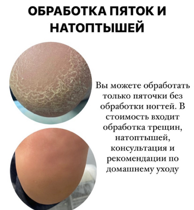 Обработка пяток и натоптышей