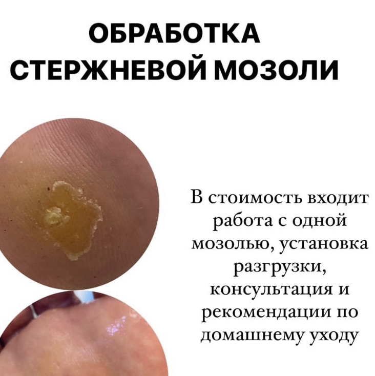 Обработка стержневой мозоли