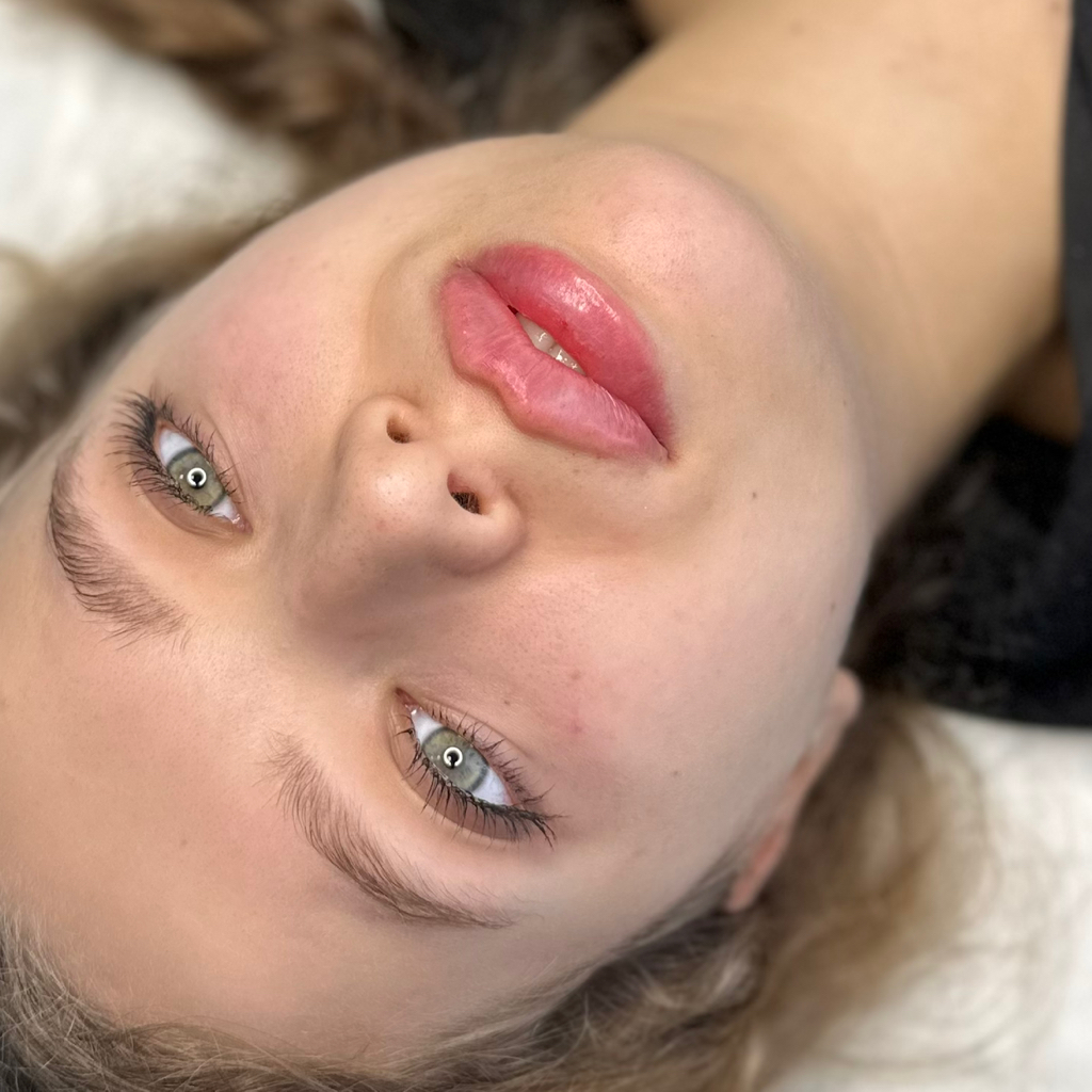 Увеличение губ Stylage L с лидокаином