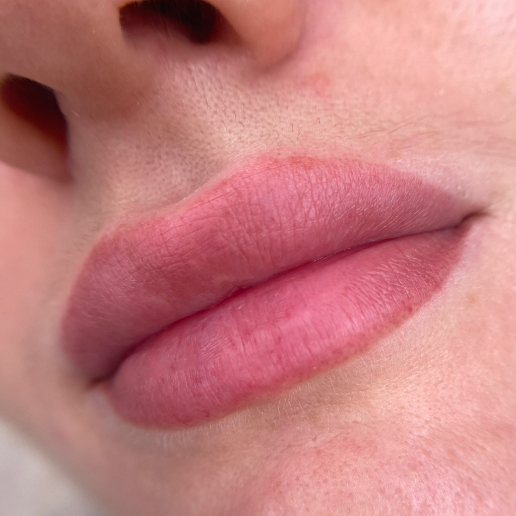 Губы. Коррекция до 6 месяцев