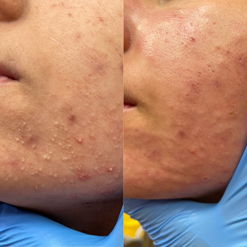 Акне-стоп( себорегуляция/увлажнение)