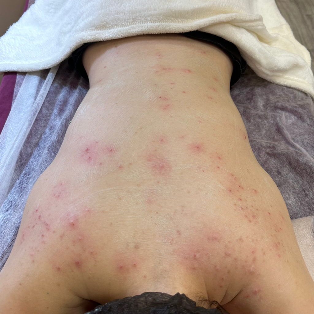 Чистка спины+пилинг