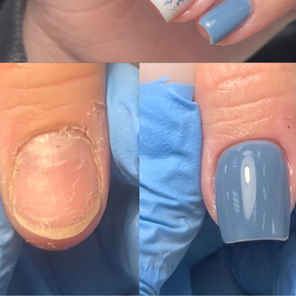 Ремонт ногтя