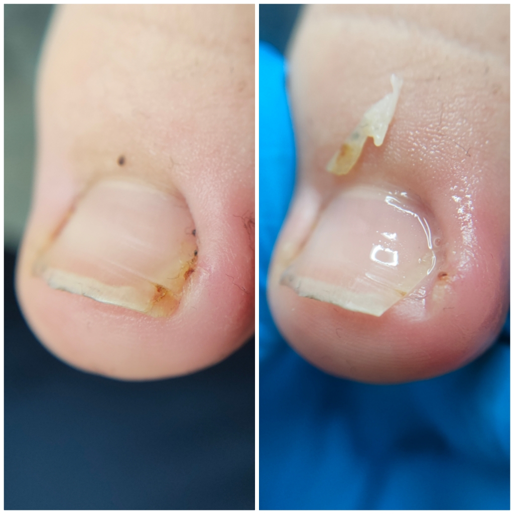 Обработка вросшего ногтя