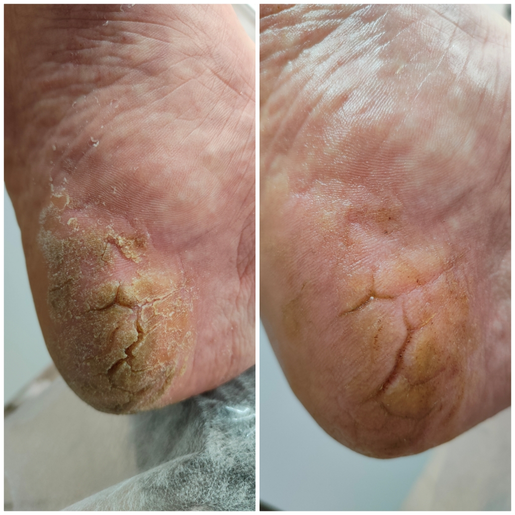 Обработка стоп с глубокими трещинами или сильным ороговением