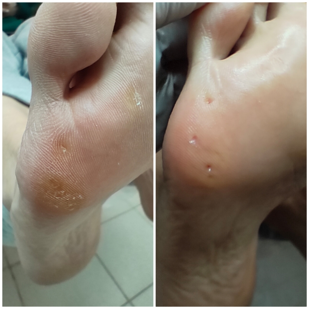 Обработка мозоли (1 шт.)