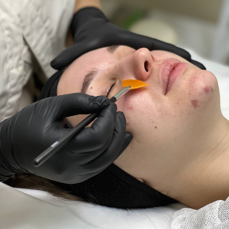 Химический пилинг (срединный)