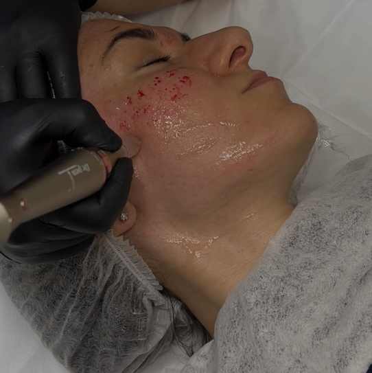 Фракционная мезотерапия (Дермапен)